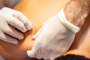 Punción seca ecoguiada por fisioterapeuta